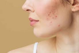 How Do You Treat Hormonal Acne Symptoms Naturally?