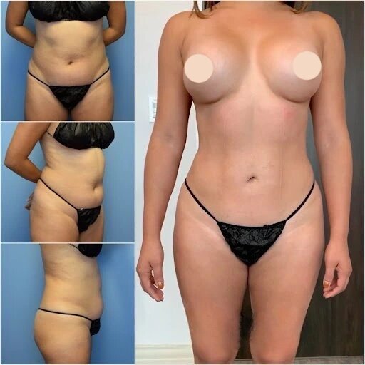 The Benefits of Choosing Body Contouring in Dubai